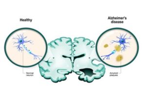 Healthy brain VS brain with alzheimer's